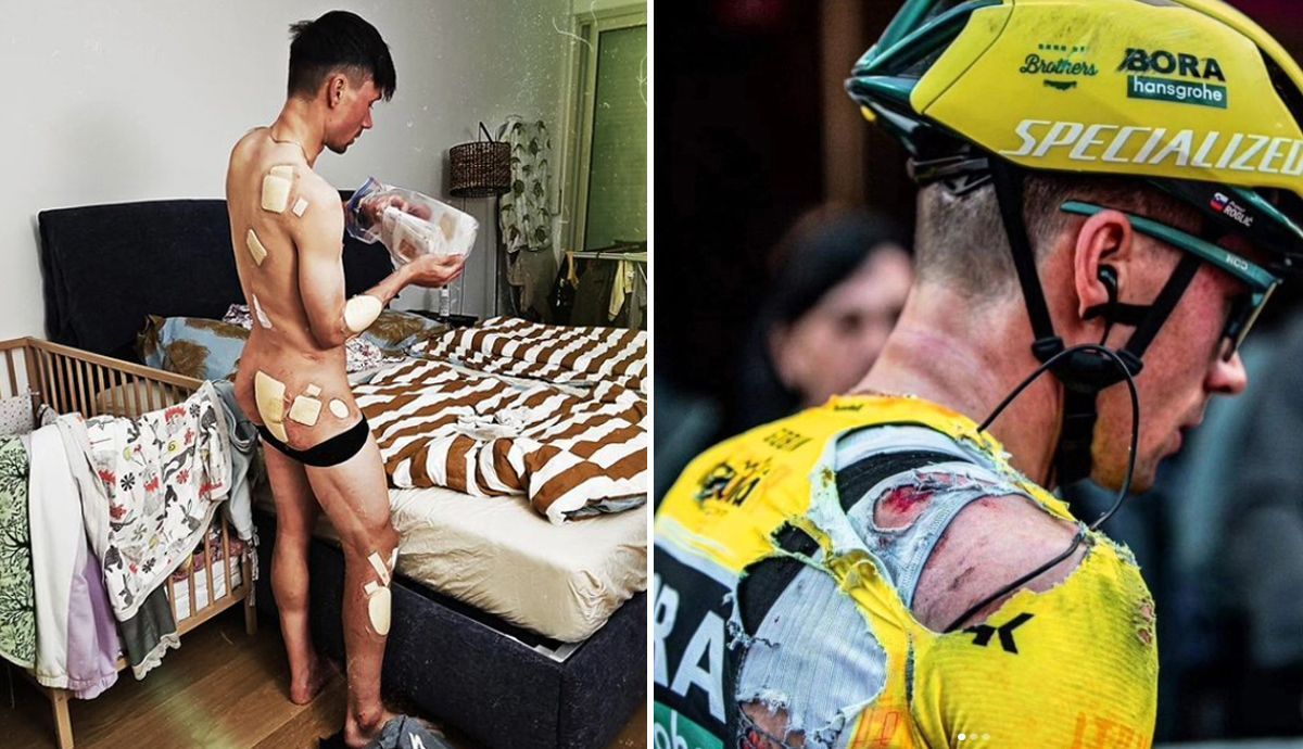 Primoz Roglic mostra as feridas que o levaram a abandonar a Itzulia